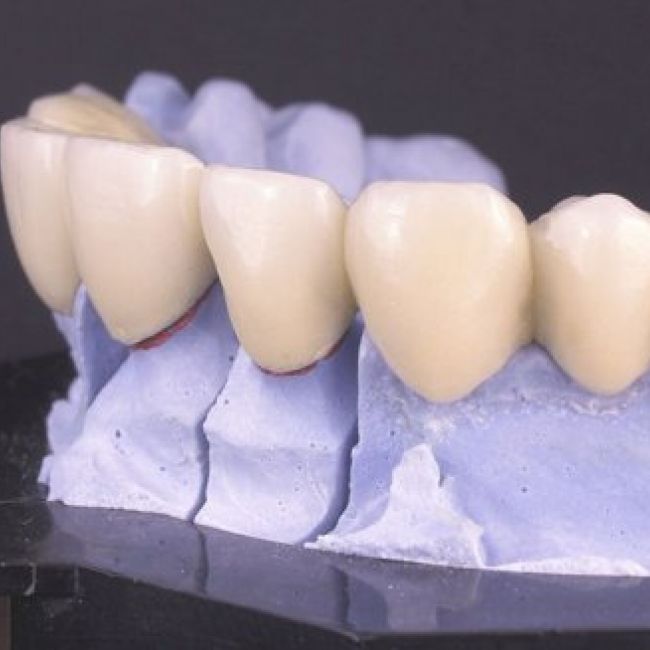 implantes dentales Leganés